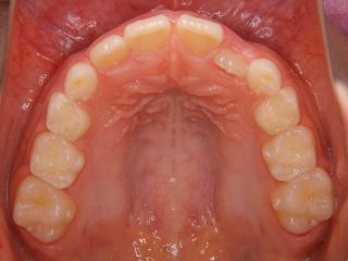 子供のマウスピース矯正症例:治療前