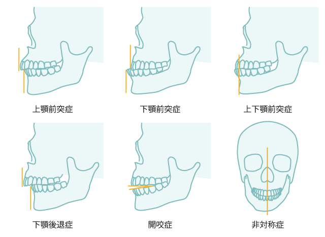 顎変形症の症状